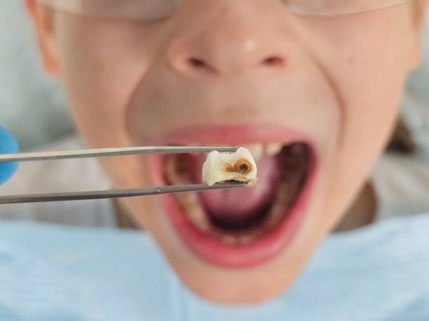 Best Emergency Dentist for Knocked-Out Tooth in Troup, TX